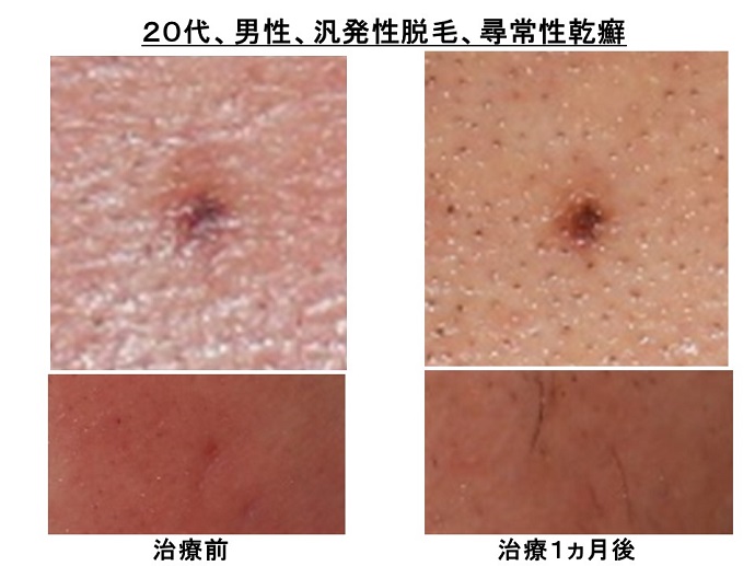汎発性脱毛　病院